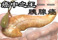 胰腺癌