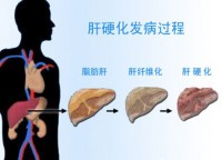 肝硬化可以治愈吗